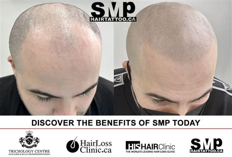scalp micropigmentation regrets|Scalp Micropigmentation Treatments In Toronto .